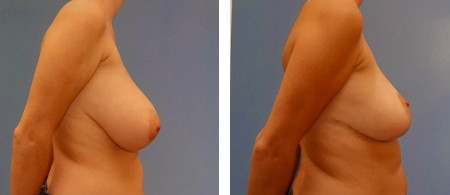 Breast reduction